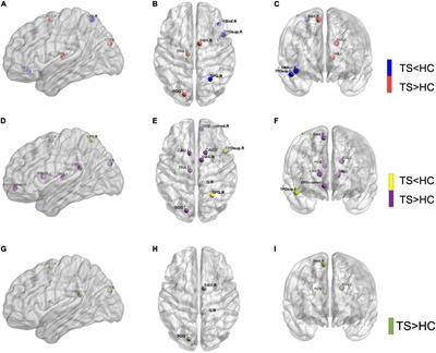 The Alternation of Gray Matter Morphological Topology in Drug-Naïve Tourette’s Syndrome in Children